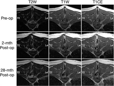 Case Report: Recurrence of an Extradural Spinal Epidermoid Cyst Following Surgical Excision in a Dog